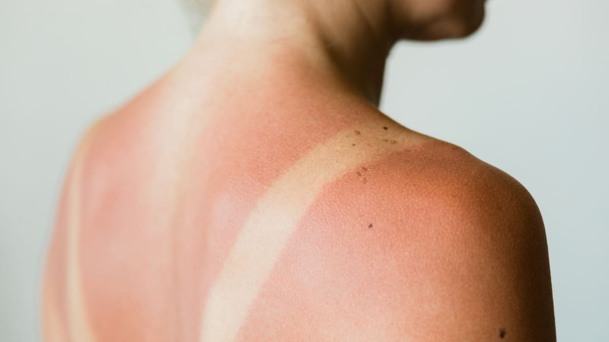 Premiers coups de soleil